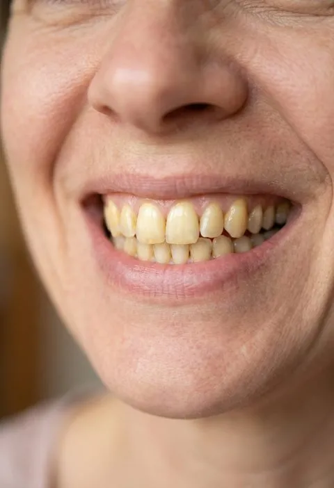 My Nana’s 2-Minute Teeth Whitening Trick Actually Worked… But There’s a Catch